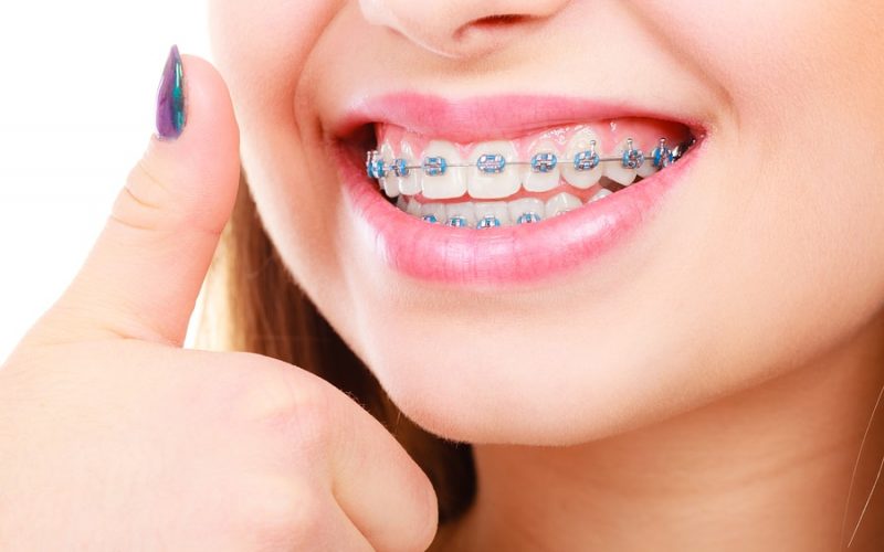 Questions about Orthodontic Treatment